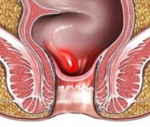 Причината за хемороиди при жените и мъжете, превенцията на болестта