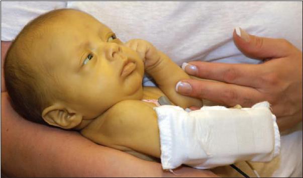 Симптом на жълтеница при новородени: видове и признаци на хепатит
