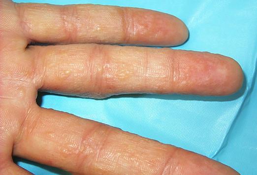 Водни везикули на пръстите: симптоматика и лечение